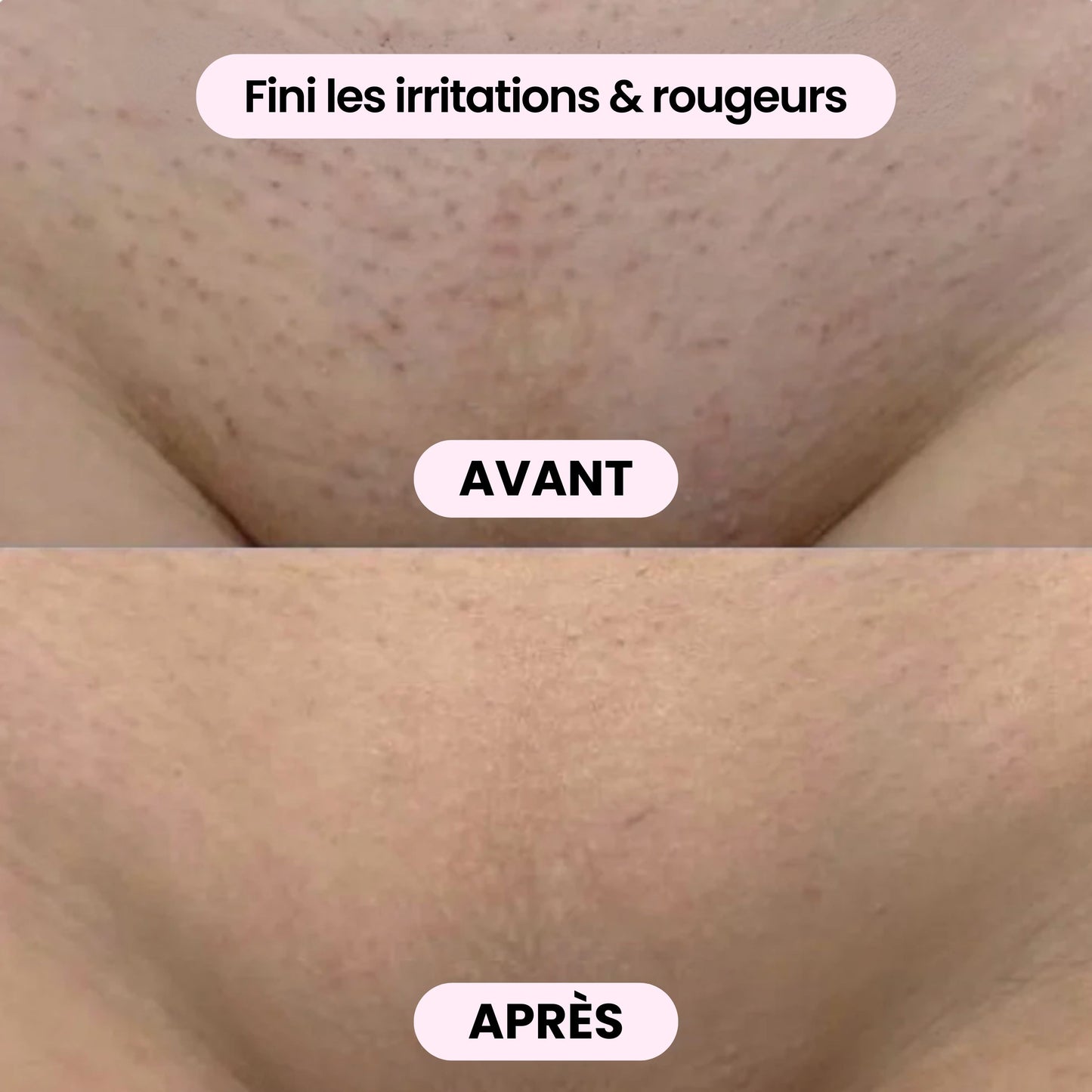 Máquina 2 em 1 corpo e biquíni - BODYKLYNE